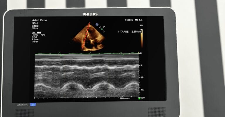Ekran aparatu Philips Affiniti 50G z zapisem M-mode pomiaru TAPSE 2,65 cm i czerwoną linią kursora M-mode przez boczną część pierścienia trójdzielnego w projekcji koniuszkowej czterojamowej