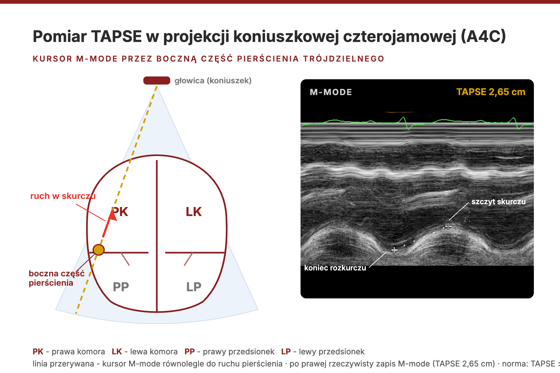 Schemat pomiaru TAPSE: kursor M-mode przez boczną część pierścienia trójdzielnego w projekcji koniuszkowej czterojamowej (A4C) oraz zapis M-mode z pomiarem amplitudy